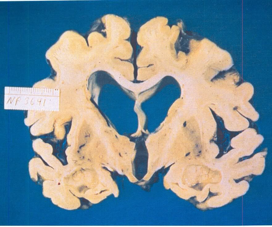 brain_alz.jpg