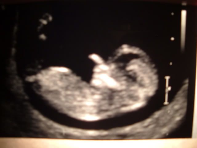 12 5 week ultrasound. I had my 12 week ultrasound